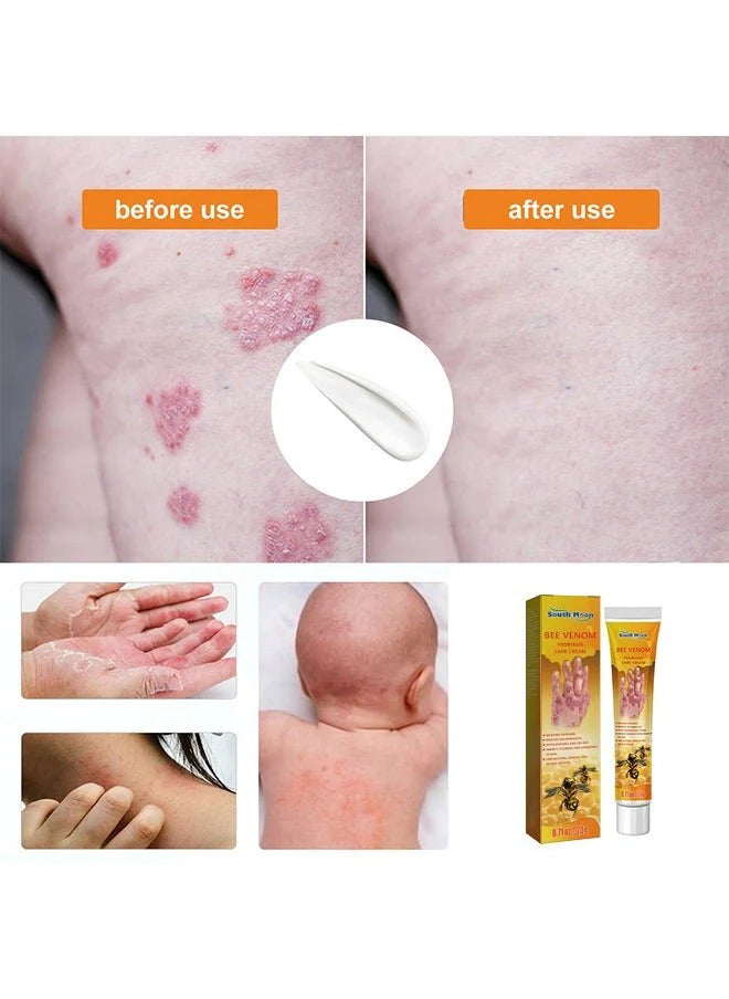 “South Moon - Bee Venom Psoriasis Care Cream (Original)”