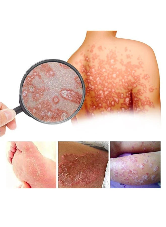 “South Moon - Bee Venom Psoriasis Care Cream (Original)”